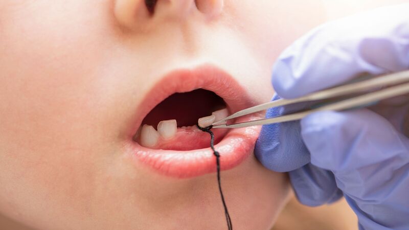 Mẹo vứt răng sữa theo từng độ tuổi